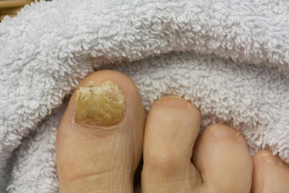 ierburi și ciuperci pe unghiile picioarelor